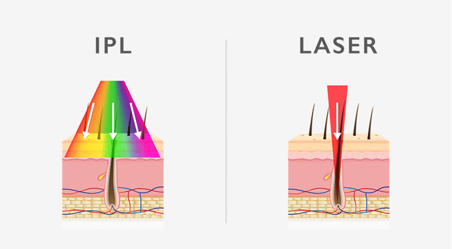 IPL laser